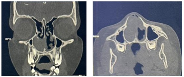 Axial/coronal facial CT scan 