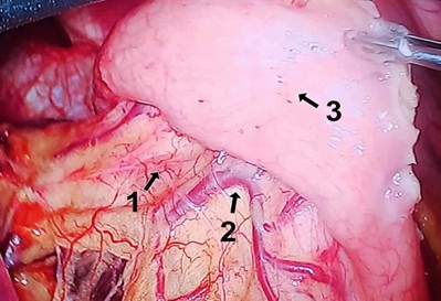 Shows GIST (arrow 3) with blood supply from the left gastric vessels (arrows 1 and 2)